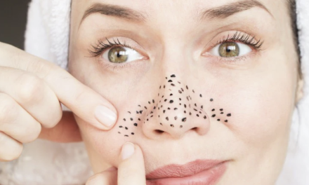 5 Best Remedies to Get rid of Blackheads at Home