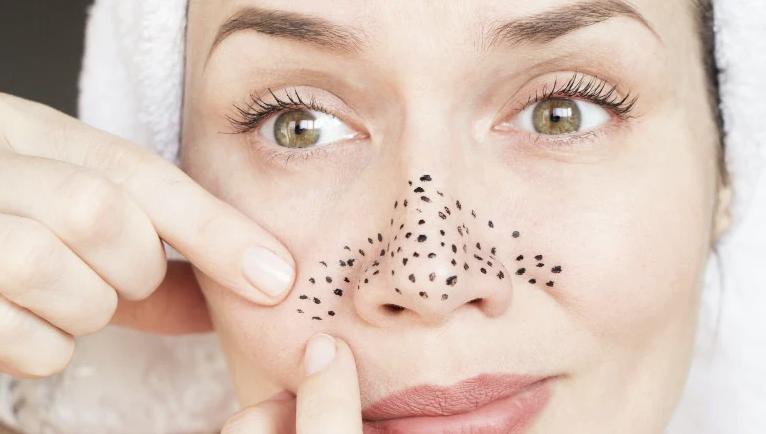 5 Best Remedies to Get rid of Blackheads at Home